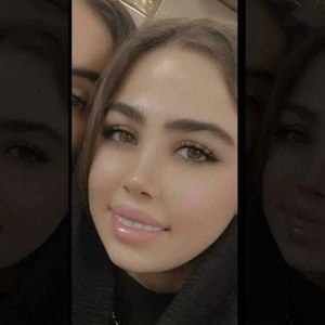 Rhinoplasty-10