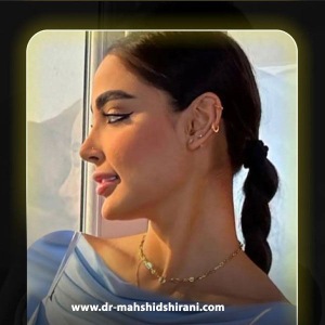Rhinoplasty-14