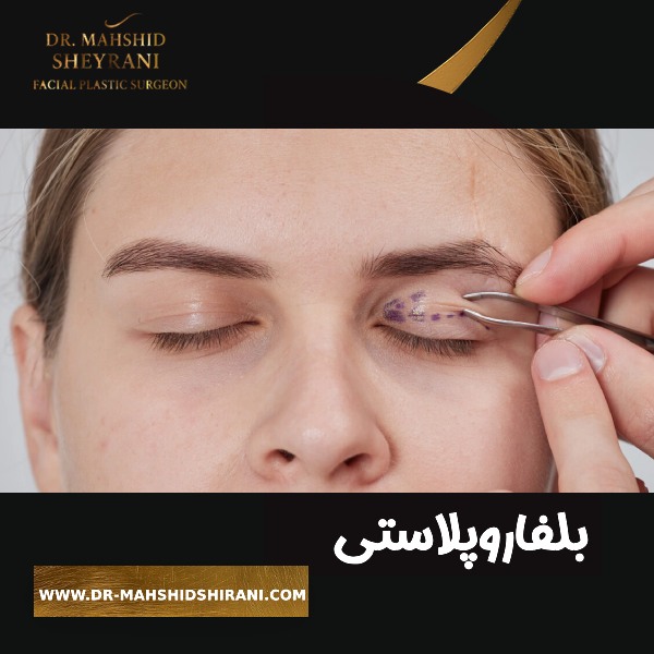 بلفاروپلاستی