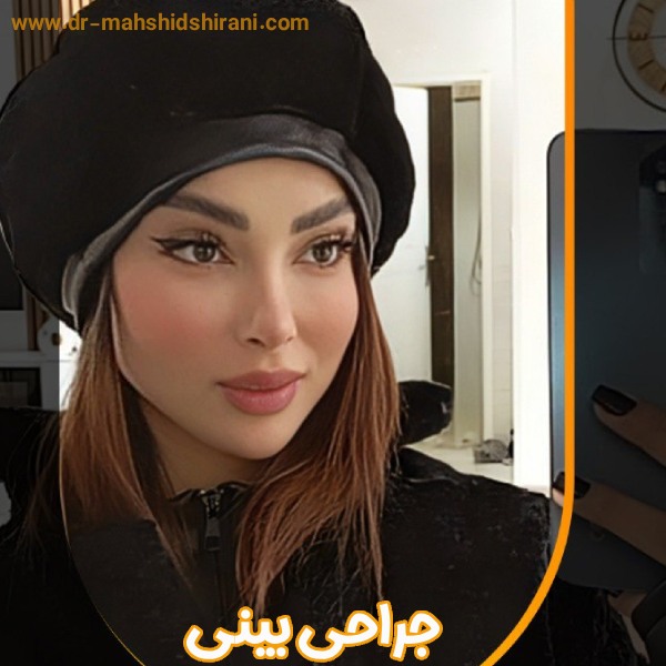 نمونه کار جراحی بینی 