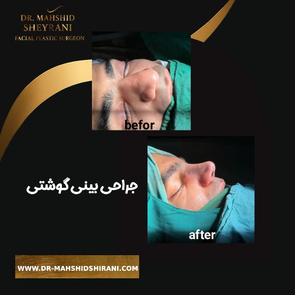 جراحی بینی گوشتی