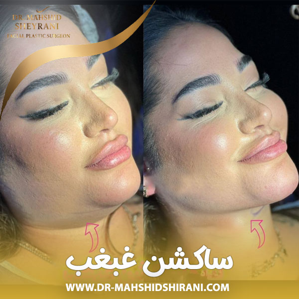 ساکشن غبغب + دکتر مهشید شیرانی