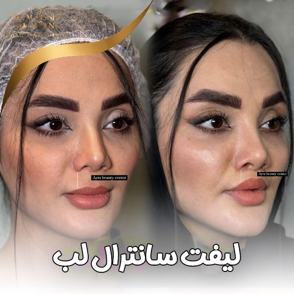 لیفت سانترال لب + دکتر مهشید شیرانی
