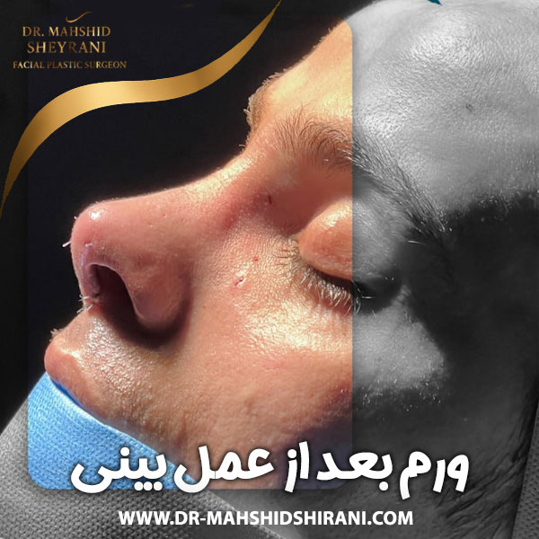 ورم بعد از عمل بینی + دکتر مهشید شیرانی