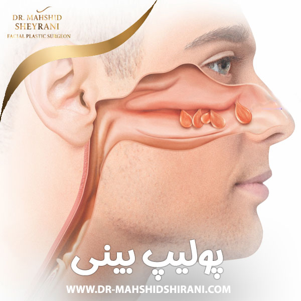 پولیپ بینی + دکتر مهشید شیرانی