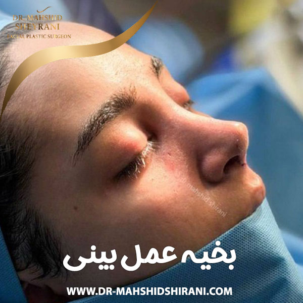 بخیه عمل بینی + دکتر مهشید شیرانی