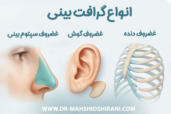 گرافت بینی + دکتر مهشید شیرانی