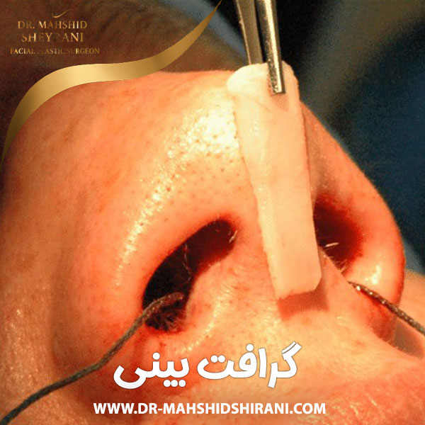 گرافت بینی + دکتر مهشید شیرانی